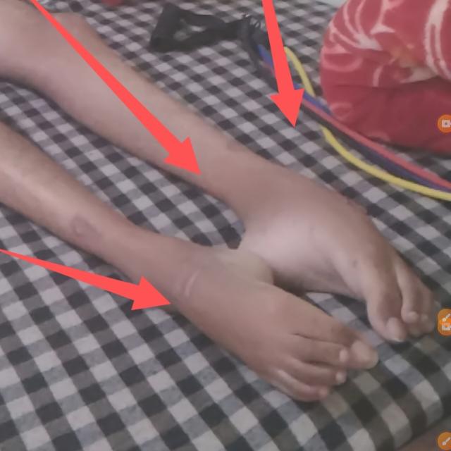 विकलांग भाई