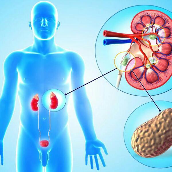 Do Din Men Pathri ka ILAJ